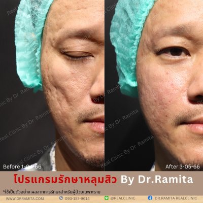 juvgen drjin ดร.จิน หลุมสิวเกาหลี รักษาหลุมสิว ศัลยกรรมหลุมสิว real scar synergy dr ramita 