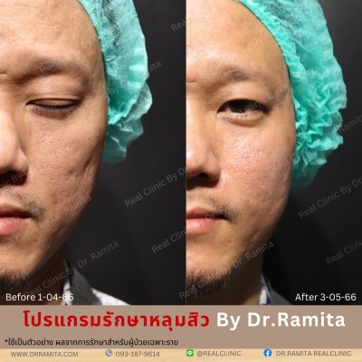 juvgen drjin ดร.จิน หลุมสิวเกาหลี รักษาหลุมสิว ศัลยกรรมหลุมสิว real scar synergy dr ramita 