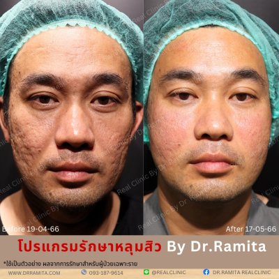 juvgen drjin ดร.จิน หลุมสิวเกาหลี รักษาหลุมสิว ศัลยกรรมหลุมสิว real scar synergy dr ramita 