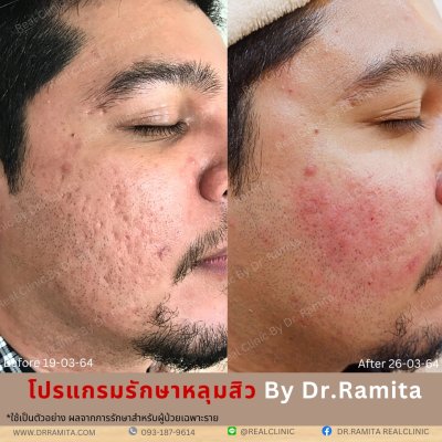 ภาพรีวิวรักษาหลุมสิว