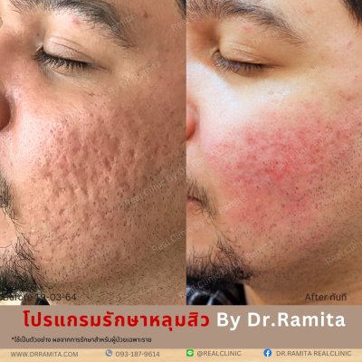 ภาพรีวิวรักษาหลุมสิว