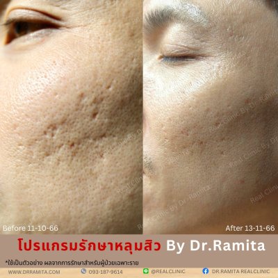 ภาพรีวิวรักษาหลุมสิว