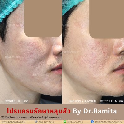 ภาพรีวิวรักษาหลุมสิว