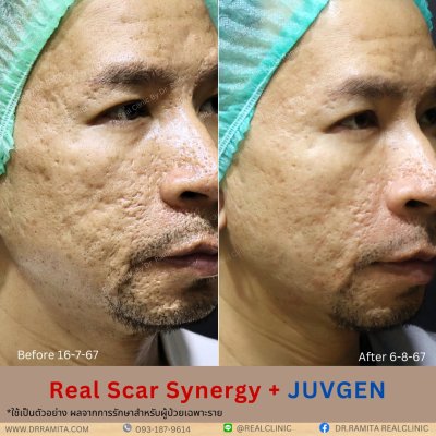 juvgen drjin ดร.จิน หลุมสิวเกาหลี รักษาหลุมสิว ศัลยกรรมหลุมสิว real scar synergy dr ramita 