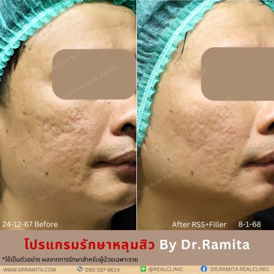 ภาพรีวิวรักษาหลุมสิว