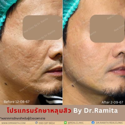 juvgen drjin ดร.จิน หลุมสิวเกาหลี รักษาหลุมสิว ศัลยกรรมหลุมสิว real scar synergy dr ramita 