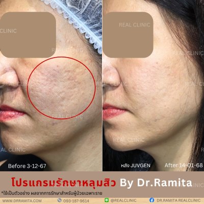 รักษาหลุมสิว,ตัดพังผืด,รักษาหลุมสิว, วิธีรักษาหลุมสิว, Subcision, เติมฟิลเลอร์, Real Scar Synergy, รักษาหลุมสิวที่ไหนดี,Juvgen,acnescarsurgery,acnescarrevision,รักษาหลุมสิวให้ตื้น,เลเซอร์หลุมสิว, รักษาหลุมสิวที่ดีที่สุด,รักษาหลุมสิวให้หายขาด,หลุมสิว,realc