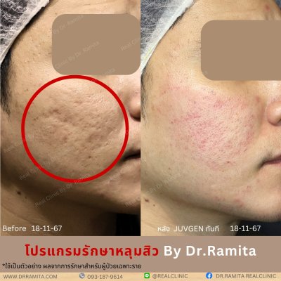 juvgen drjin ดร.จิน หลุมสิวเกาหลี รักษาหลุมสิว ศัลยกรรมหลุมสิว real scar synergy dr ramita  รีวิวหลุมสิว