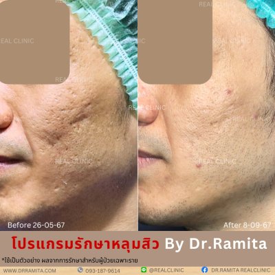 ภาพรีวิวรักษาหลุมสิว