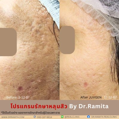 juvgen drjin ดร.จิน หลุมสิวเกาหลี รักษาหลุมสิว ศัลยกรรมหลุมสิว real scar synergy dr ramita  รีวิวหลุมสิว