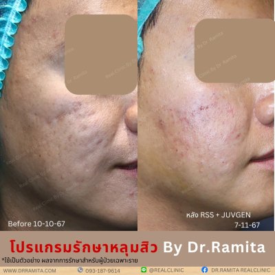 juvgen drjin ดร.จิน หลุมสิวเกาหลี รักษาหลุมสิว ศัลยกรรมหลุมสิว real scar synergy dr ramita 