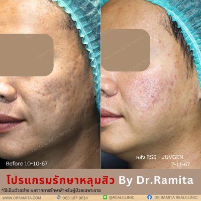 juvgen drjin ดร.จิน หลุมสิวเกาหลี รักษาหลุมสิว ศัลยกรรมหลุมสิว real scar synergy dr ramita  รีวิวหลุมสิว