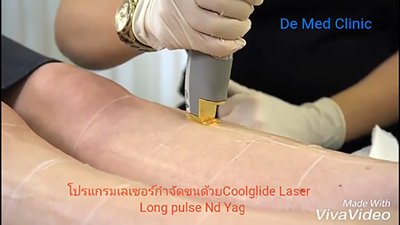 ผิวเรียบเนียน ปราศจากขนด้วย เลเซอร์กำจัดขน USA CoolGlide® CUTERA (Laser Hair Removal)