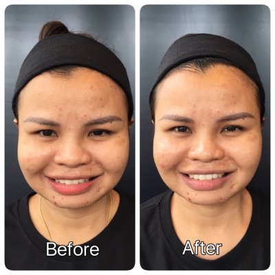 รีวิวก่อนและหลังเข้าโปรแกรมดูแลผิวหน้าและดูแลหนังศรีษะกับ DeMed Clinic