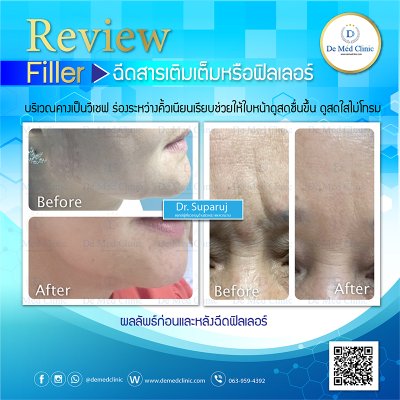 Review Picosecond Laser รักษาหลุมสิว ช่วยดูแลการเกิดแผลเป็นนูน Hypertrophic scar หรือ Keloid หลังจากการผ่าตัด