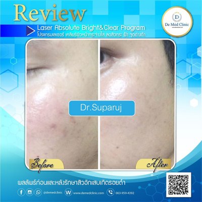 Review ผลการรักษาด้วยโปรแกรม Picosecond Laser  และโปรแกรมต่างๆ และ ผู้ใช้บริการที่ DeMed Clinic