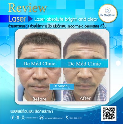 Review ผลการรักษาด้วยโปรแกรม Picosecond Laser  และโปรแกรมต่างๆ และ ผู้ใช้บริการที่ DeMed Clinic