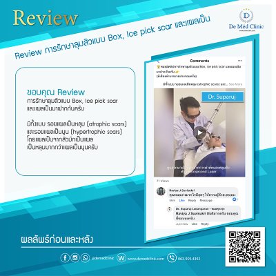 Review Picosecond Laser รักษาหลุมสิว ช่วยดูแลการเกิดแผลเป็นนูน Hypertrophic scar หรือ Keloid หลังจากการผ่าตัด