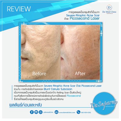 Picosecond Laser ช่วยดูแล หลุมสิว การเกิดแผลเป็นนูน Hypertrophic scar หรือ Keloid หลังจากการผ่าตัด