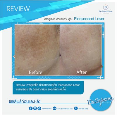 Picosecond Laser ช่วยดูแล หลุมสิว การเกิดแผลเป็นนูน Hypertrophic scar หรือ Keloid หลังจากการผ่าตัด