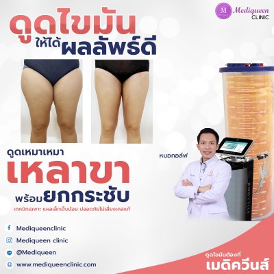 รีวิวดูดไขมันต้นขา