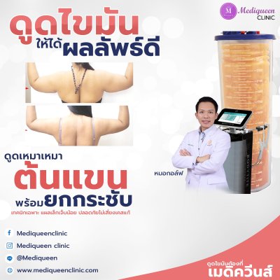 รีวิวดูดไขมันต้นแขน