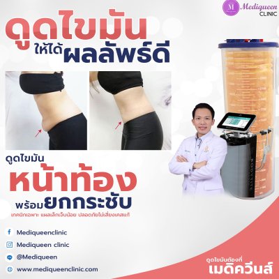 รีวิวดูดไขมันหน้าท้อง