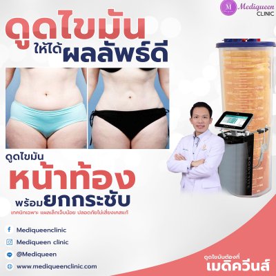 รีวิวดูดไขมันหน้าท้อง