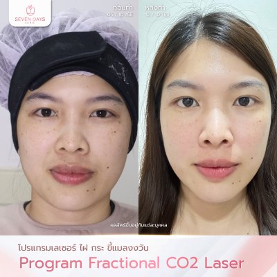 รีวิวโปรแกรม รักษาฝ้า