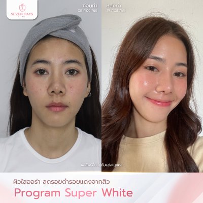รีวิว Meso Super White