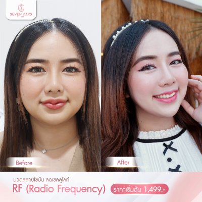 รีวิว RF