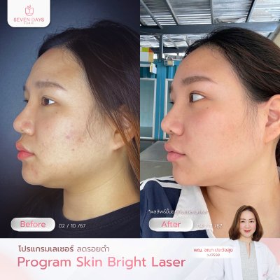 รีวิวโปรแกรม  Skin Bright
