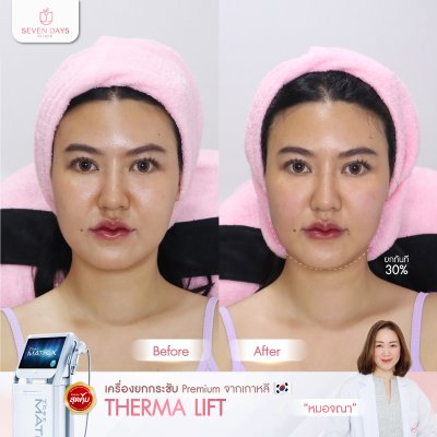 รีวิว Therma Lift