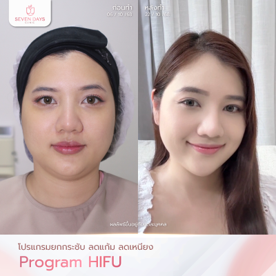 รีวิวโปรแกรม Hifu