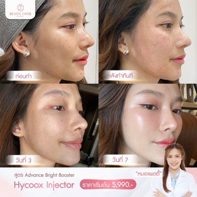 รีวิว Hycoox