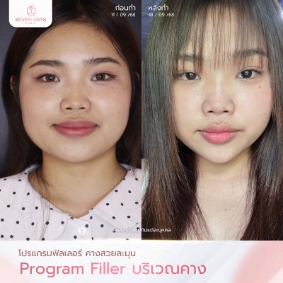 รีวิว Filler