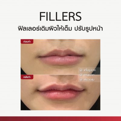 Review Facial Design by Fillers