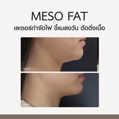 Review Meso Fat