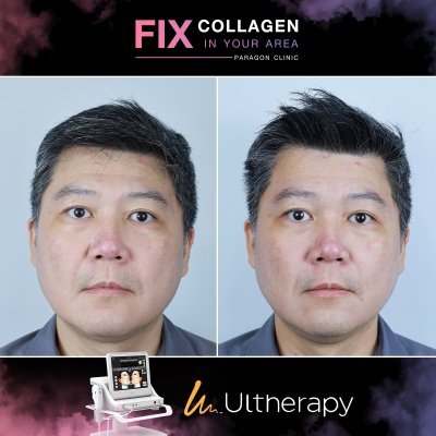 Fix Collagen In Your Area Skin Lifting