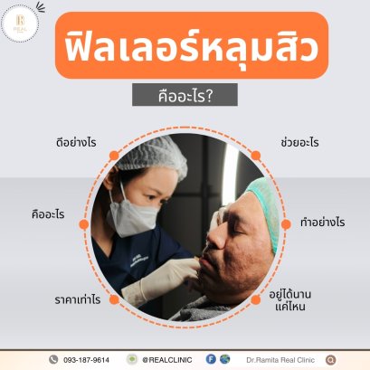 ฟิลเลอร์หลุมสิวคืออะไร ฉีดฟิลเลอร์หลุมสิวดีไหม รักษาหลุมสิว ด้วยฟิลเลอร์หลุมสิว !? 