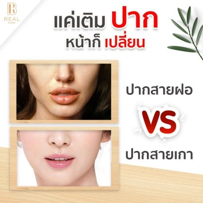 ฟิลเลอร์ปาก 