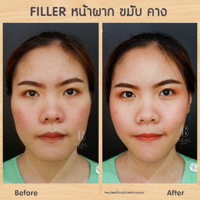 ฉีดฟิลเลอร์ขมับ คาง หน้าผาก กับหมอเบนซ์ Real Clinic