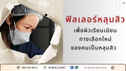 ฟิลเลอร์หลุมสิว: ทางเลือกใหม่ของคนเป็นหลุมสิว เพื่อผิวเรียบเนียน 2025