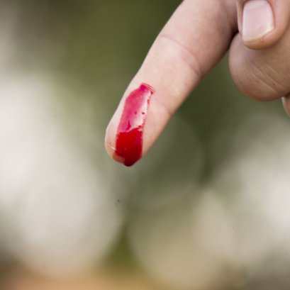 การเตรียมพื้นของแผล(wound bed preparation)