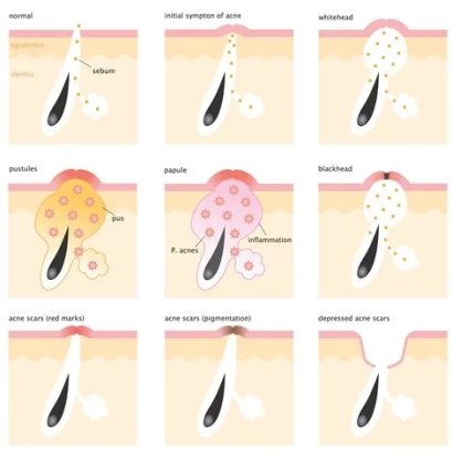 หลุมสิวเกิดจากอะไร สิวเกิดขึ้นได้อย่างไร สิวคืออะไร 