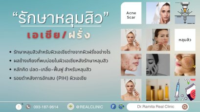 รักษาหลุมสิวฉบับผิวเอเชีย: ทำไมต้องรักษาคนละวิธีกับฝรั่ง? 