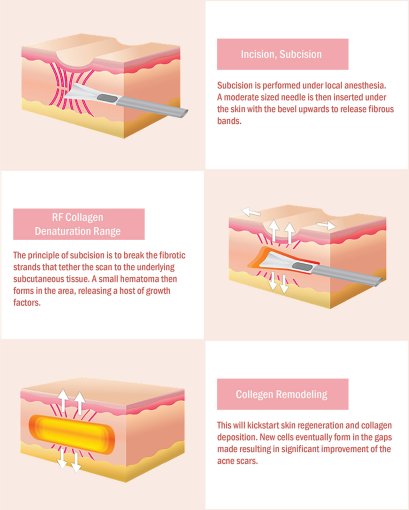 subcision หลุมสิว คืออะไร? ทำแล้วดีอย่างไร 