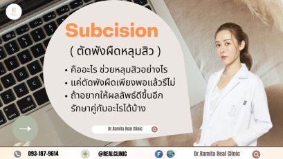 subcision ตัดพังผืด