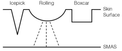 หลุมสิวแต่ละแบบรักษาต่างกันอย่างไร??