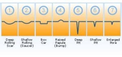 หลุมสิวเกิดจากอะไร? หลุมสิวมีกี่แบบ 
